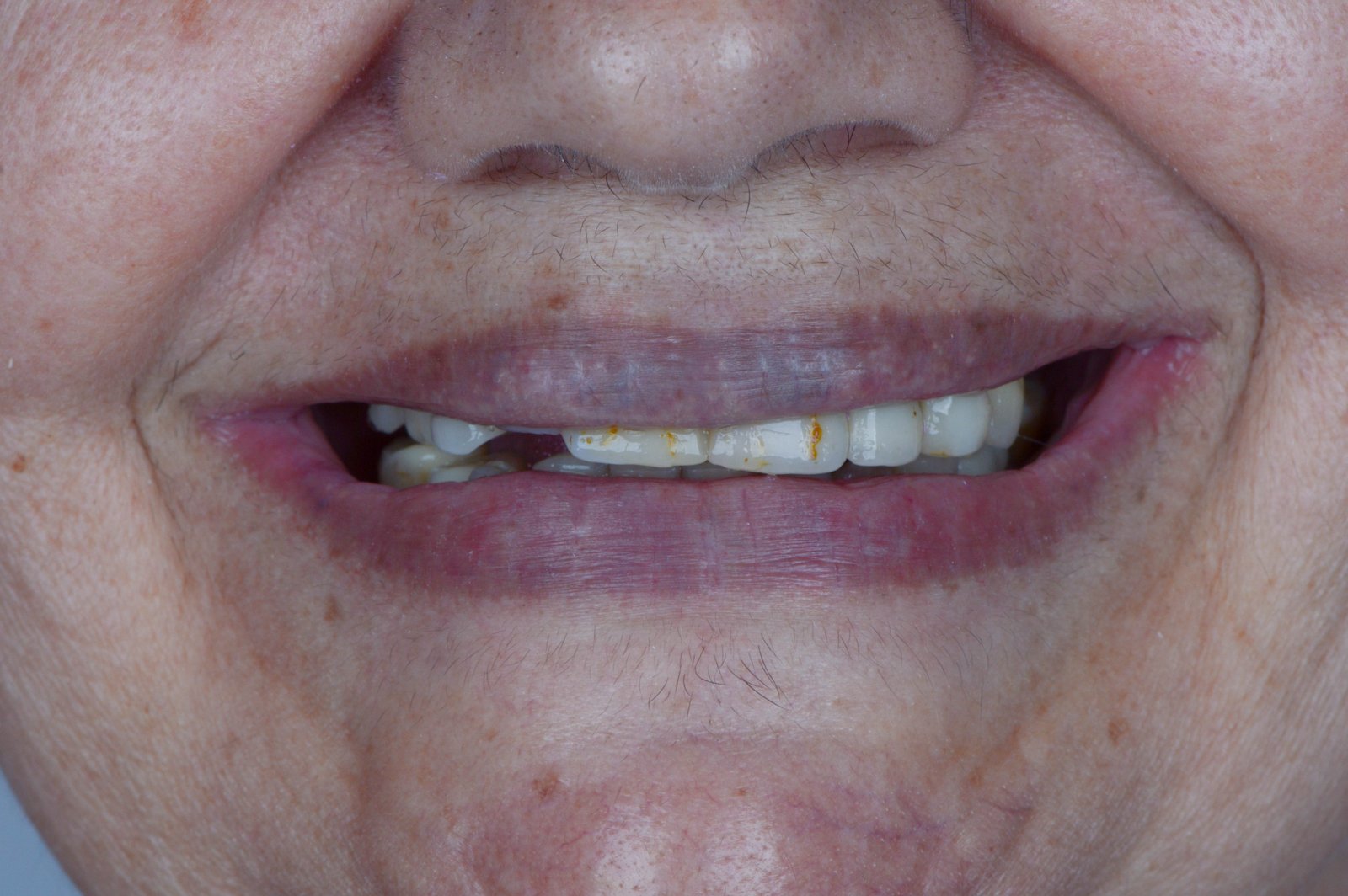 Antes | Antes e depois | implante dentário unitário