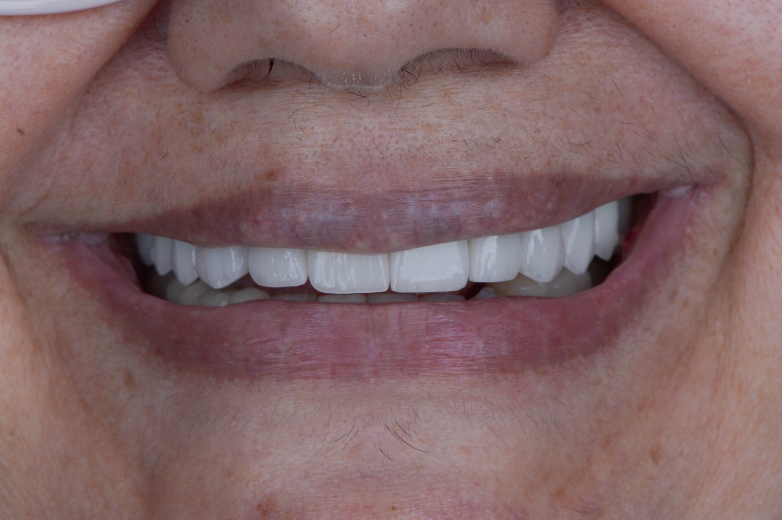 Depois | Antes e depois | implante dentário unitário