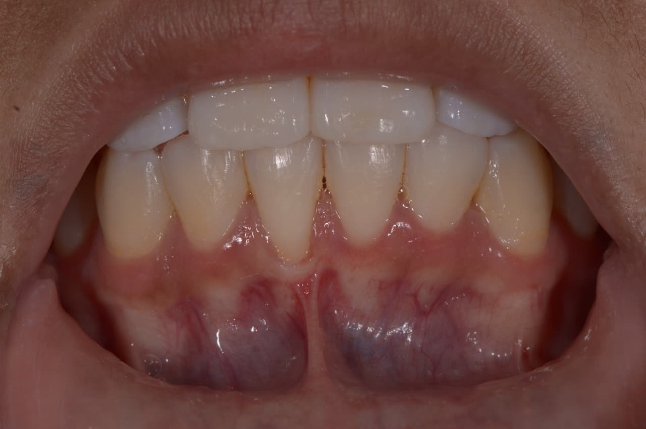 Antes | Antes e depois | tratamento periodontal