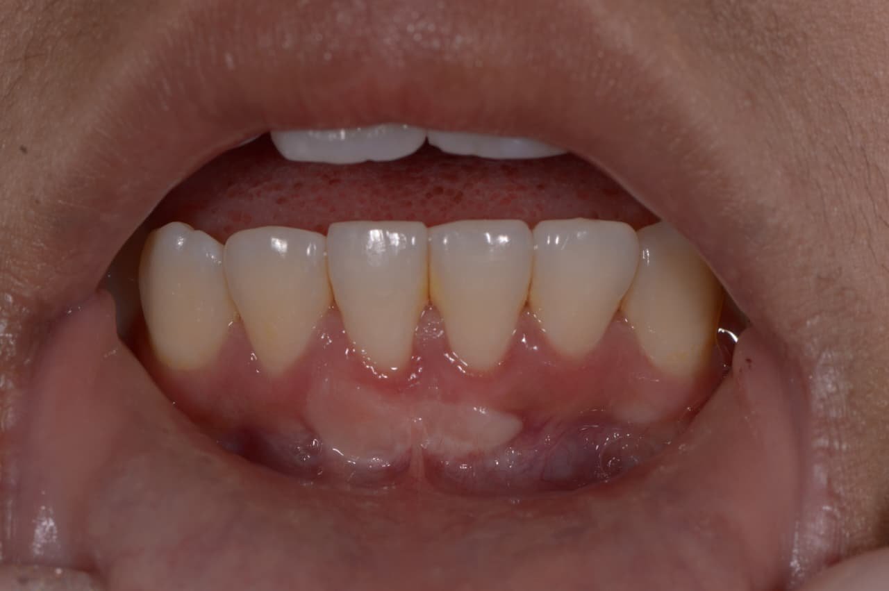 Depois | Antes e depois | tratamento periodontal