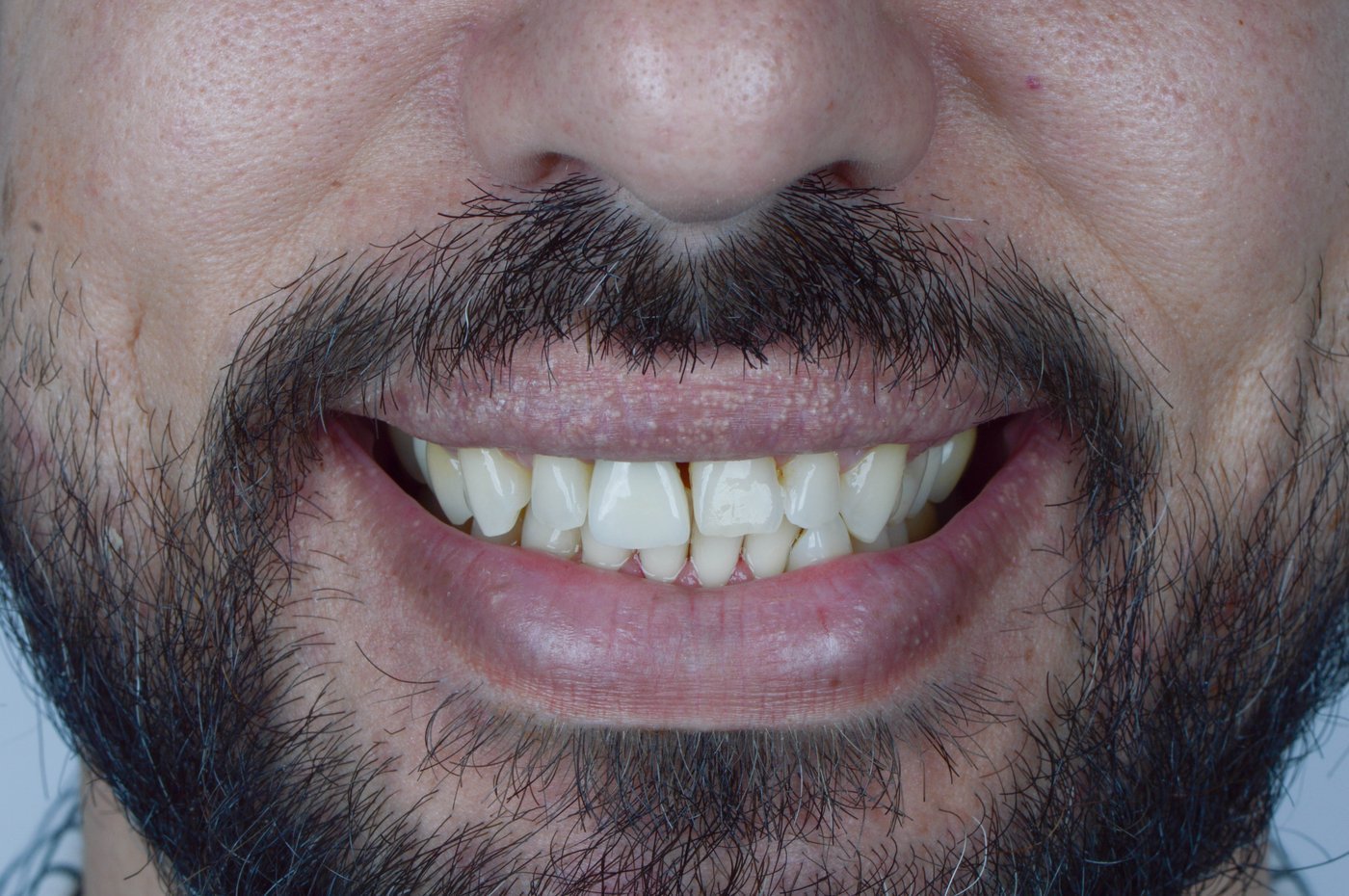 Antes | Antes e depois | Reabilitação Oral
