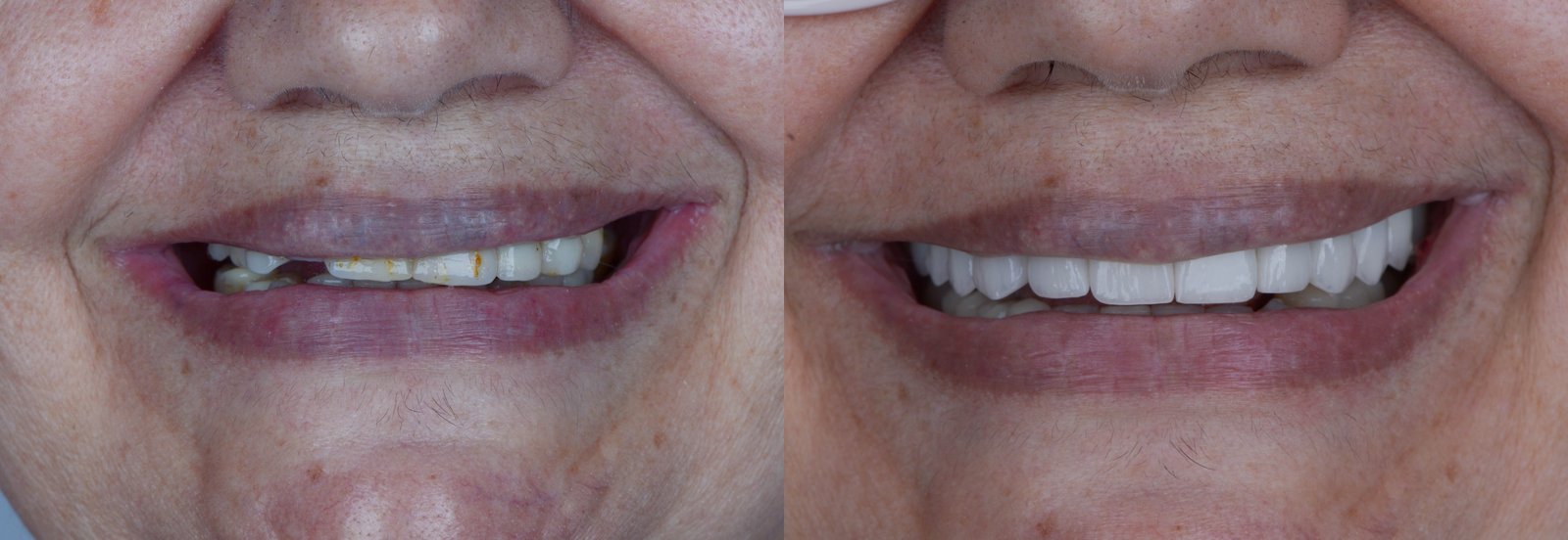 Antes e depois de implante dentário, caso 3