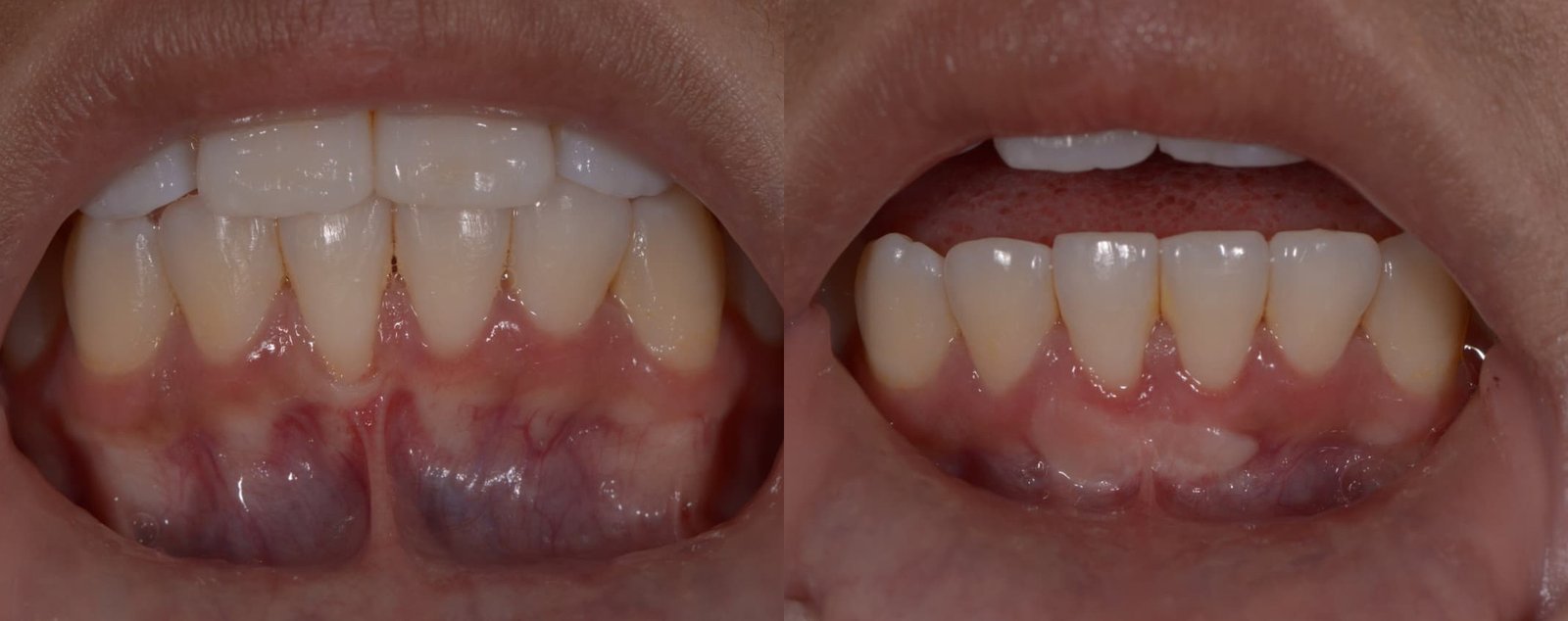 Antes e depois de tratamento periodontal, caso 1