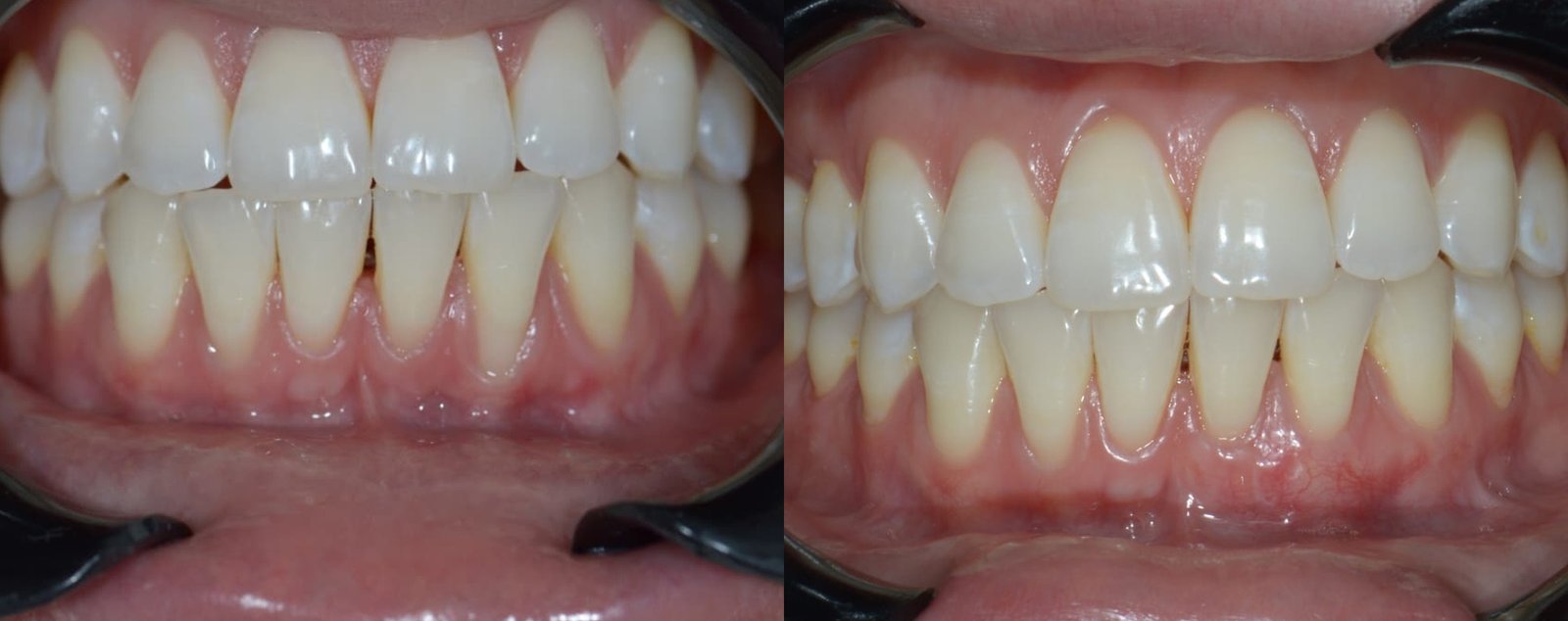 Antes e depois de tratamento periodontal, caso 3